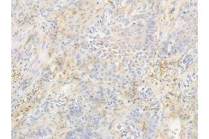 ABIN6257943 and ABIN6274678 at 1/100 staining human lung squamous cell carcinoma by IHC-P. (BCL2L2 Antikörper  (N-Term))