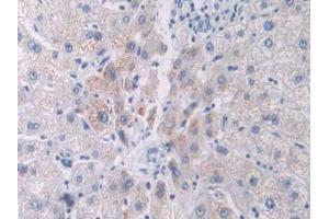 Used in DAB staining on fromalin fixed paraffin- embedded liver cancer tissue (PCOLCE Antikörper  (AA 315-437))
