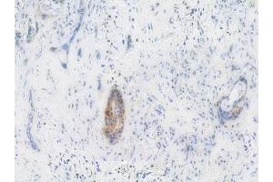 ABIN6256686 and ABIN6267254 at 1/100 staining human pancreatic carcinoma by IHC-P. (ABL1 Antikörper  (pTyr245))