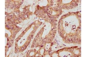 Immunohistochemistry (IHC) image for anti-Matrix Metallopeptidase 3 (Stromelysin 1, Progelatinase) (MMP3) (AA 104-477) antibody (ABIN7177875)