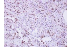 IHC-P Image Immunohistochemical analysis of paraffin-embedded human lung adenocarcinoma, using SLU7, antibody at 1:250 dilution. (SLU7 Antikörper  (C-Term))