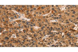 Immunohistochemistry of paraffin-embedded Human liver cancer tissue using CD159a/c Polyclonal Antibody at dilution 1:30 (CD159a/c Antikörper)