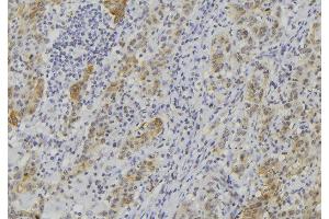 ABIN6273508 at 1/100 staining Human lung cancer tissue by IHC-P. (GZMK Antikörper  (Internal Region))