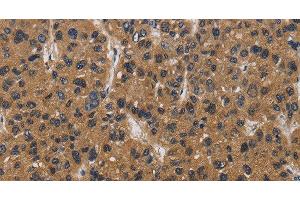 Immunohistochemistry of paraffin-embedded Human liver cancer tissue using E2F4 Polyclonal Antibody at dilution 1:40 (E2F4 Antikörper)