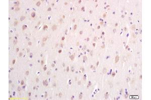 Formalin-fixed and paraffin embedded human glioma carcinoma labeled with Anti DTNB Polyclonal Antibody, Unconjugated (ABIN700630) at 1:200 followed by conjugation to the secondary antibody and DAB staining (Dystrobrevin beta Antikörper  (AA 261-370))