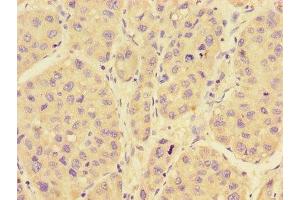 Immunohistochemistry of paraffin-embedded human liver cancer using ABIN7167280 at dilution of 1:100 (RAB28 Antikörper  (AA 98-218))