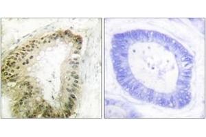 Immunohistochemistry analysis of paraffin-embedded human colon carcinoma, using LKB1 (Phospho-Ser428) Antibody. (LKB1 Antikörper  (pSer428))