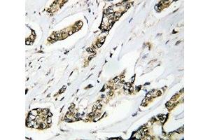 IHC-P: HSP105 antibody testing of human breast cancer tissue (HSPH1 Antikörper  (AA 713-733))