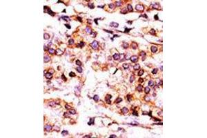 Formalin-fixed and paraffin-embedded human cancer tissue reacted with the primary antibody, which was peroxidase-conjugated to the secondary antibody, followed by AEC staining (PANK1 Antikörper  (Middle Region))