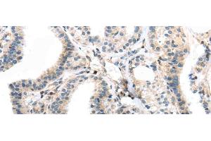 Immunohistochemistry of paraffin-embedded Human thyroid cancer using TBXA2R Polyclonal Antibody at dilution of 1/40 (TBXA2R Antikörper)