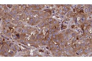 ABIN6273850 at 1/100 staining Human liver cancer tissue by IHC-P. (G Protein-Coupled Receptor 1 Antikörper  (C-Term))