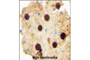 OAZ2 antibody (C-term) (ABIN654721 and ABIN2844410) immunohistochemistry analysis in formalin fixed and paraffin embedded human skin carcinoma followed by peroxidase conjugation of the secondary antibody and DAB staining. (OAZ2 Antikörper  (C-Term))