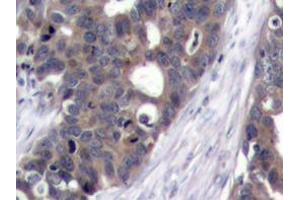Immunohistochemistry analyzes of p70 S6K antibody in paraffin-embedded human breast carcinoma tissue. (RPS6KB1 Antikörper)