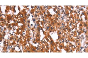 Immunohistochemistry of paraffin-embedded Human thyroid cancer using HMGCS2 Polyclonal Antibody at dilution of 1:40 (HMGCS2 Antikörper)
