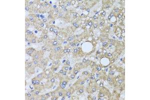 Immunohistochemistry of paraffin-embedded human liver injury using AARS2 antibody at dilution of 1:100 (x40 lens). (AARS2 Antikörper)