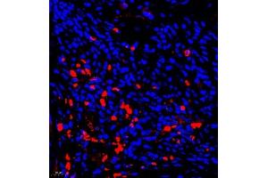 Immunofluorescence of paraffin embedded human liver cancer using AHSG (ABIN7073021) at dilution of 1:650 (400x lens) (Fetuin A Antikörper)