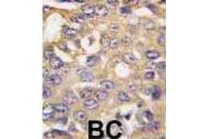 Formalin-fixed and paraffin-embedded human breast carcinoma tissue reacted with BRA1 antibody (N-term) (ABIN388572 and ABIN2849770) , which was peroxidase-conjugated to the secondary antibody, followed by DAB staining.