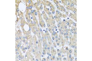 Immunohistochemistry of paraffin-embedded human liver injury using UQCRC2 antibody. (UQCRC2 Antikörper  (AA 224-453))