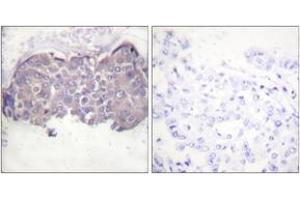 Immunohistochemistry analysis of paraffin-embedded human breast carcinoma, using HSL (Phospho-Ser552) Antibody.