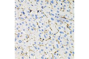Immunohistochemistry of paraffin-embedded human liver injury using SSTR2 antibody at dilution of 1:100 (x40 lens).