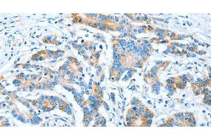 Immunohistochemistry of paraffin-embedded Human colon cancer using IMMT Polyclonal Antibody at dilution of 1:70 (IMMT Antikörper)