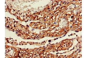 IHC image of ABIN7158511 diluted at 1:600 and staining in paraffin-embedded human lung cancer performed on a Leica BondTM system. (ACSL5 Antikörper  (AA 33-683))