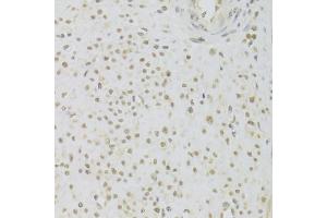 Immunohistochemistry of paraffin-embedded human leiomyoma of uterus using PRPF3 Antibody (ABIN5973192) at dilution of 1/100 (40x lens). (PRPF3 Antikörper)