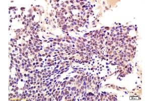 Formalin-fixed and paraffin embedded human lung carcinoma labeled with Anti-RNF56/CBLB Polyclonal Antibody, Unconjugated (ABIN760256) at 1:200 followed by conjugation to the secondary antibody and DAB staining. (Cbl Proto-Oncogene B, E3 Ubiquitin Protein Ligase (CBLB) (AA 101-200) Antikörper)