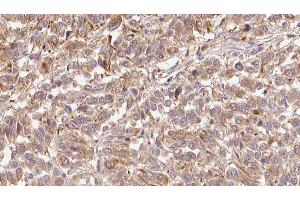 ABIN6279428 at 1/100 staining Human Melanoma tissue by IHC-P. (Fibulin 1 Antikörper  (Internal Region))