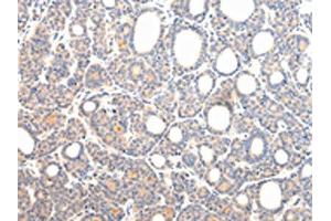 The image on the left is immunohistochemistry of paraffin-embedded Human thyroid cancer tissue using ABIN7131592(VPS54 Antibody) at dilution 1/20, on the right is treated with fusion protein. (VPS54 Antikörper)