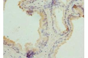 Immunohistochemistry of paraffin-embedded human prostate cancer using ABIN7173912 at dilution of 1:100 (TPD52L1 Antikörper  (AA 1-144))