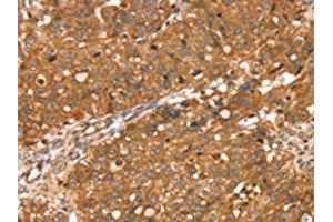 The image on the left is immunohistochemistry of paraffin-embedded Human breast cancer tissue using ABIN7130892(RNASET2 Antibody) at dilution 1/30, on the right is treated with fusion protein. (RNASET2 Antikörper)