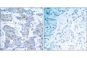 Immunohistochemistry analysis of paraffin-embedded human breast carcinoma tissue, using HER2 (Ab-1248) Antibody. (ErbB2/Her2 Antikörper  (AA 1206-1255))