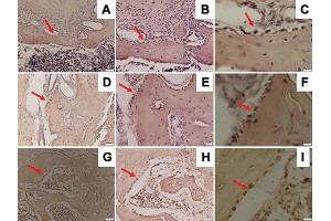 Representative images of immunohistochemical RANKL expression in the mandible of Wistar rats in diabetic group with ×200 magnification (A), ×400 magnification (B), ×1,000 magnification (C); osteoporotic group with ×200 magnification (D), ×400 magnification (E), ×1,000 magnification (F); and control group with ×200 magnification (G), ×400 magnification (H), ×1,000 magnification (I); and RANKL-positive cells were observed (red arrow). (RANKL Antikörper  (AA 74-308))