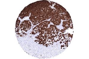 Skin Malignant melanoma with strong S100B positivity in all tumor cells (Rekombinanter S100A1 Antikörper)