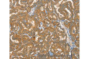 Immunohistochemistry of Human liver cancer using RAB25 Polyclonal Antibody at dilution of 1:40 (RAB25 Antikörper)