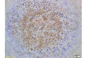 Formalin-fixed and paraffin embedded mouse lymphoma labeled with Anti-Smad3 Polyclonal Antibody, Unconjugated (ABIN747023) at 1:200 followed by conjugation to the secondary antibody and DAB staining